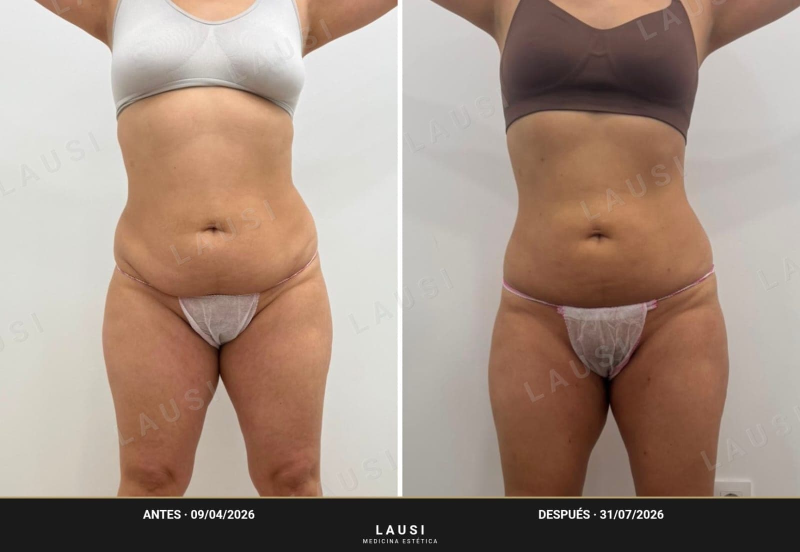 Antes y después frontal de Smartlipo de abdomen en LAUSI, Madrid: vientre más plano y cintura definida casi cuatro meses después de la lipólisis láser