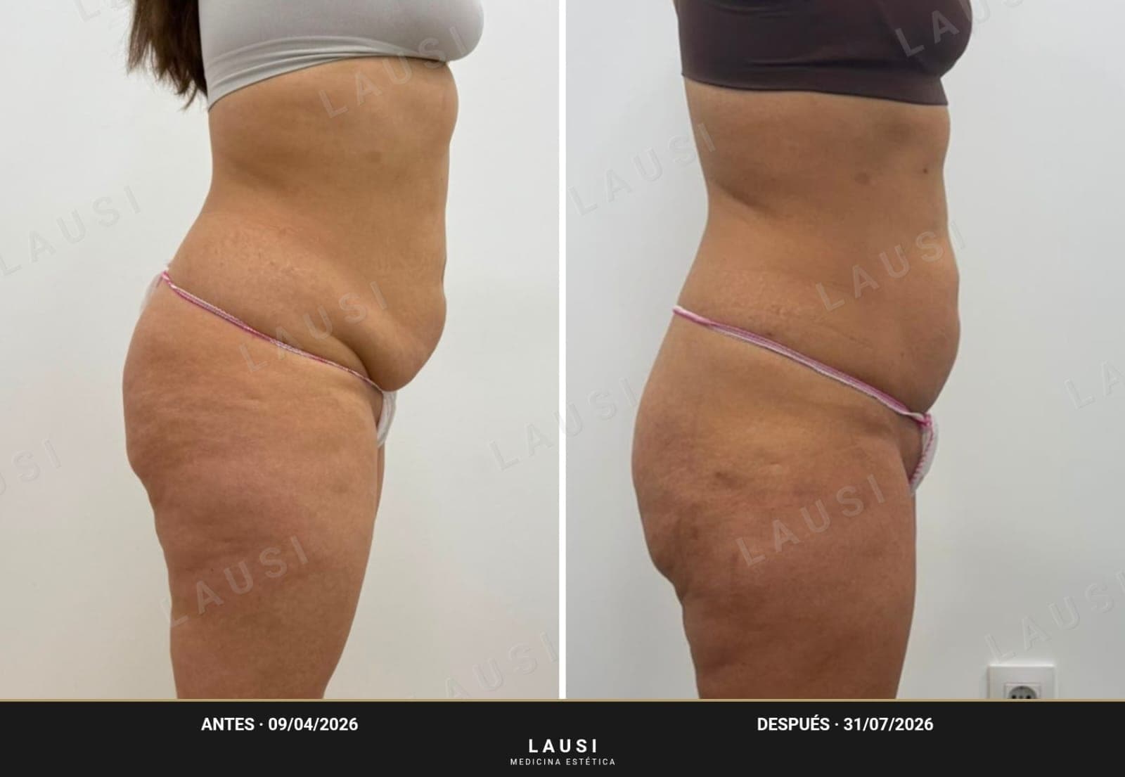 Antes y después de perfil de Smartlipo de abdomen en LAUSI, Madrid: contorno abdominal más plano casi cuatro meses después de la lipólisis láser