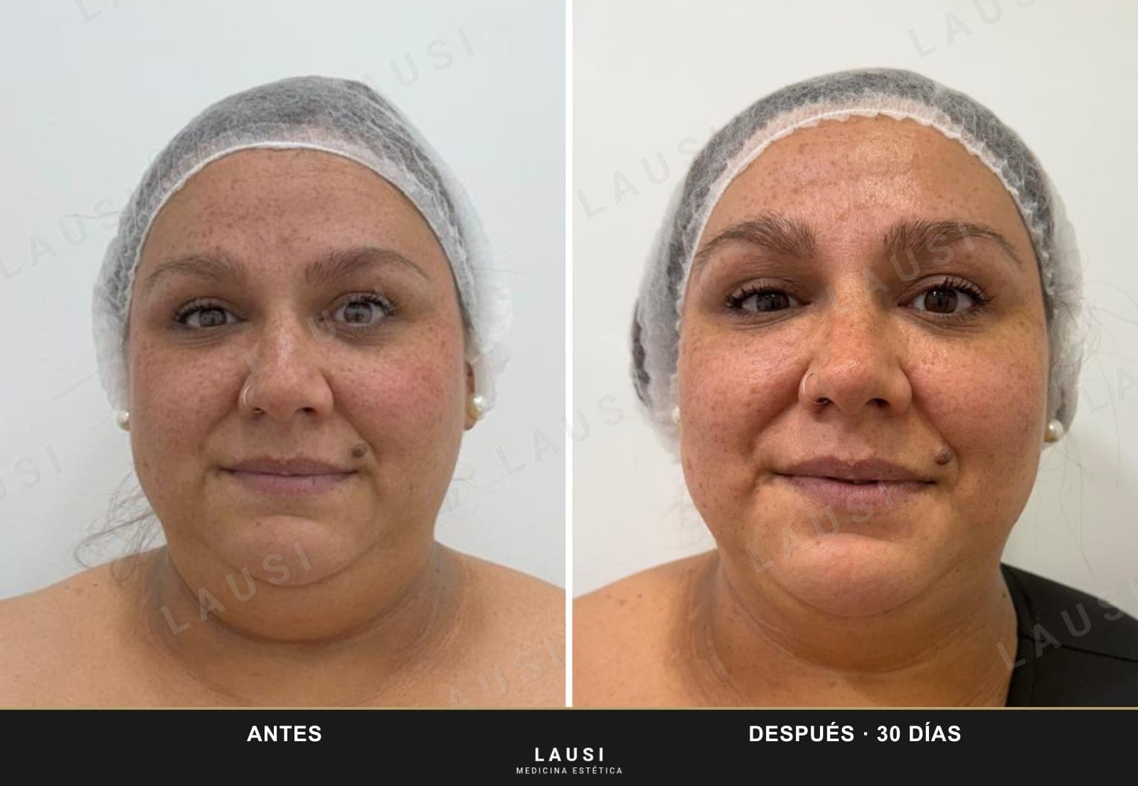 Antes y después de Smartlipo de papada en LAUSI, Madrid: mandíbula más definida y menos volumen submentoniano treinta días después de la lipólisis láser