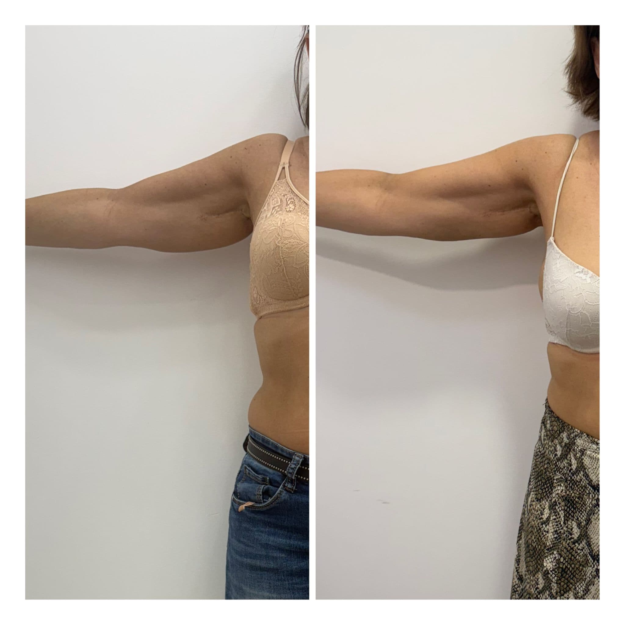 Antes y después de Smartlipo de brazos en la clínica LAUSI de Madrid: cara interna del brazo con menos grasa y piel más firme tras la lipólisis láser