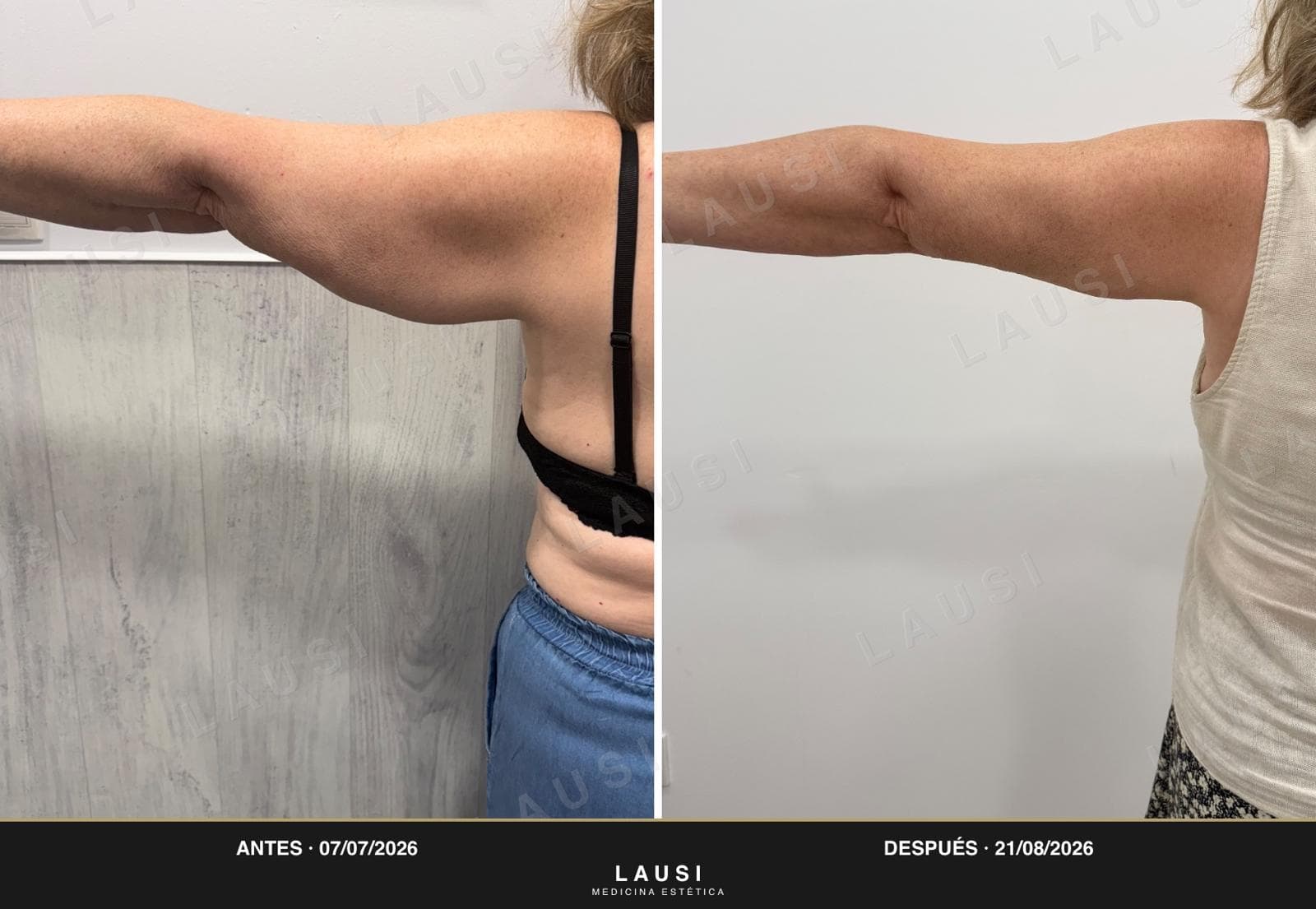 Antes y después de Smartlipo de brazos en la clínica LAUSI de Madrid: cara interna del brazo con menos grasa y piel más firme tras la lipólisis láser