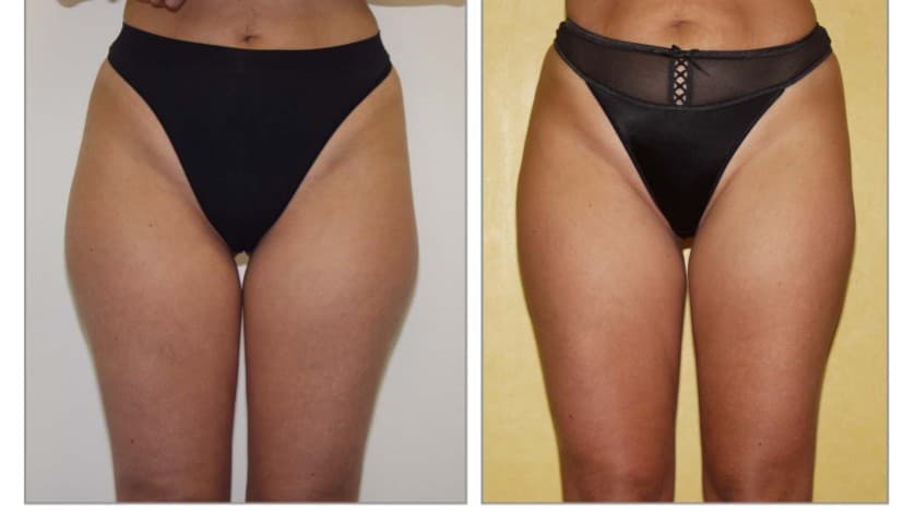 Antes y después de Smartlipo de cartucheras en la clínica LAUSI de Madrid: contorno de cadera y muslos más armónico tras la lipólisis láser