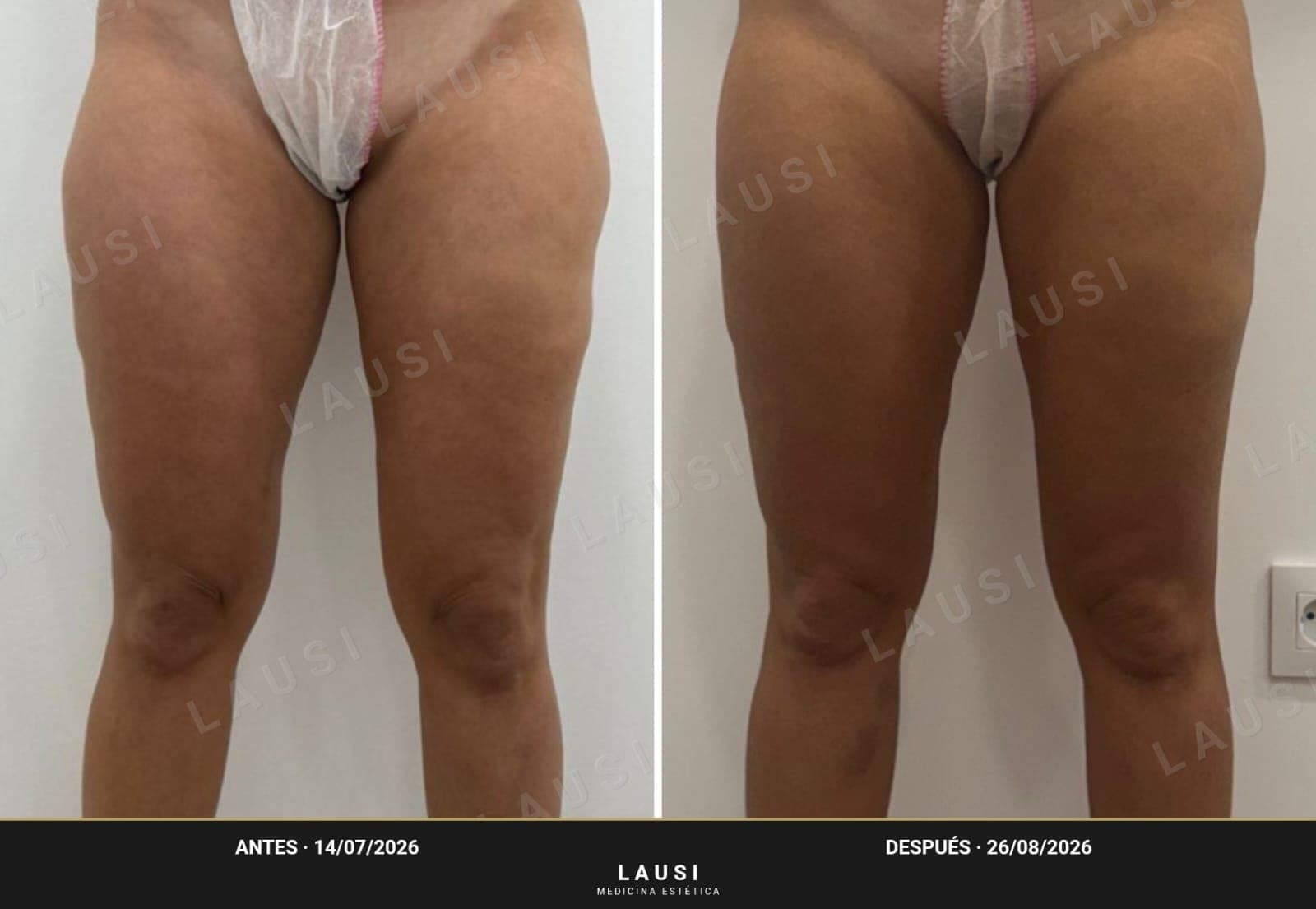 Antes y después de Smartlipo de cartucheras en la clínica LAUSI de Madrid: contorno de cadera y muslos más armónico tras la lipólisis láser