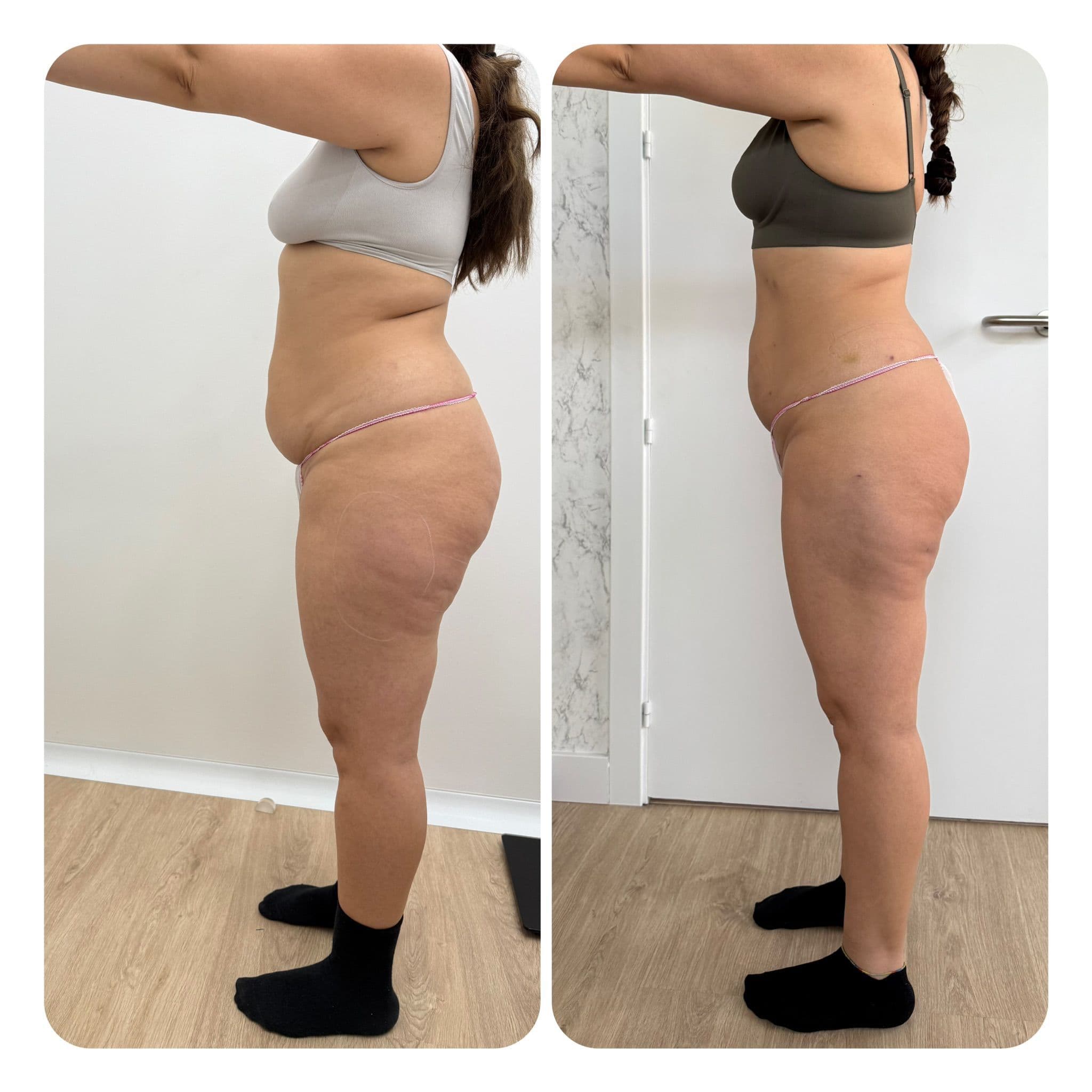 Antes y después de Smartlipo de abdomen en la clínica LAUSI de Madrid: perfil de paciente con el abdomen visiblemente más plano tras la lipólisis láser
