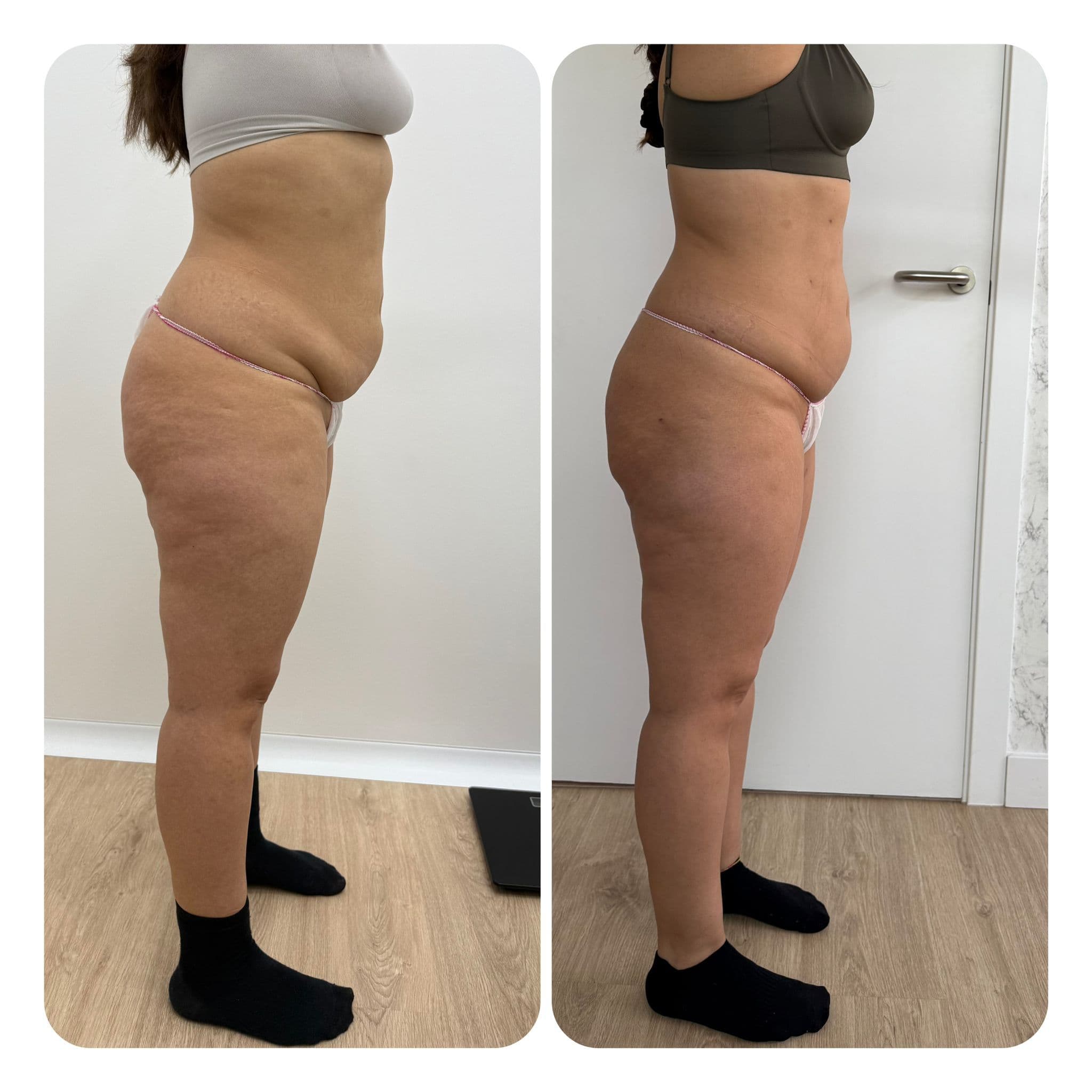 Antes y después de lipólisis láser Smartlipo de abdomen y flancos en la clínica LAUSI de Madrid: reducción visible de la grasa localizada