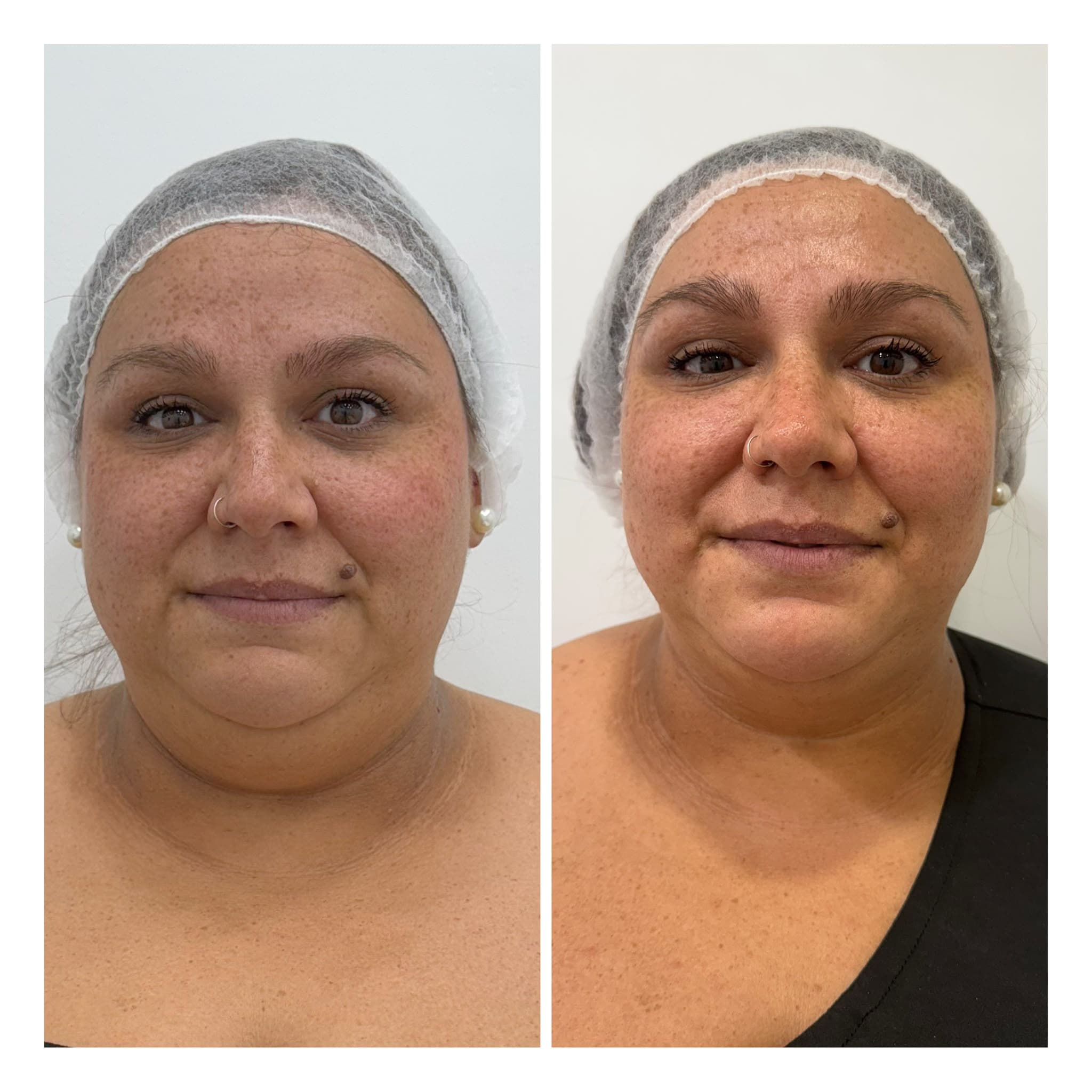 Antes y después frontal de tratamiento Smartlipo de papada en LAUSI, Madrid: óvalo facial más definido tras la lipólisis láser