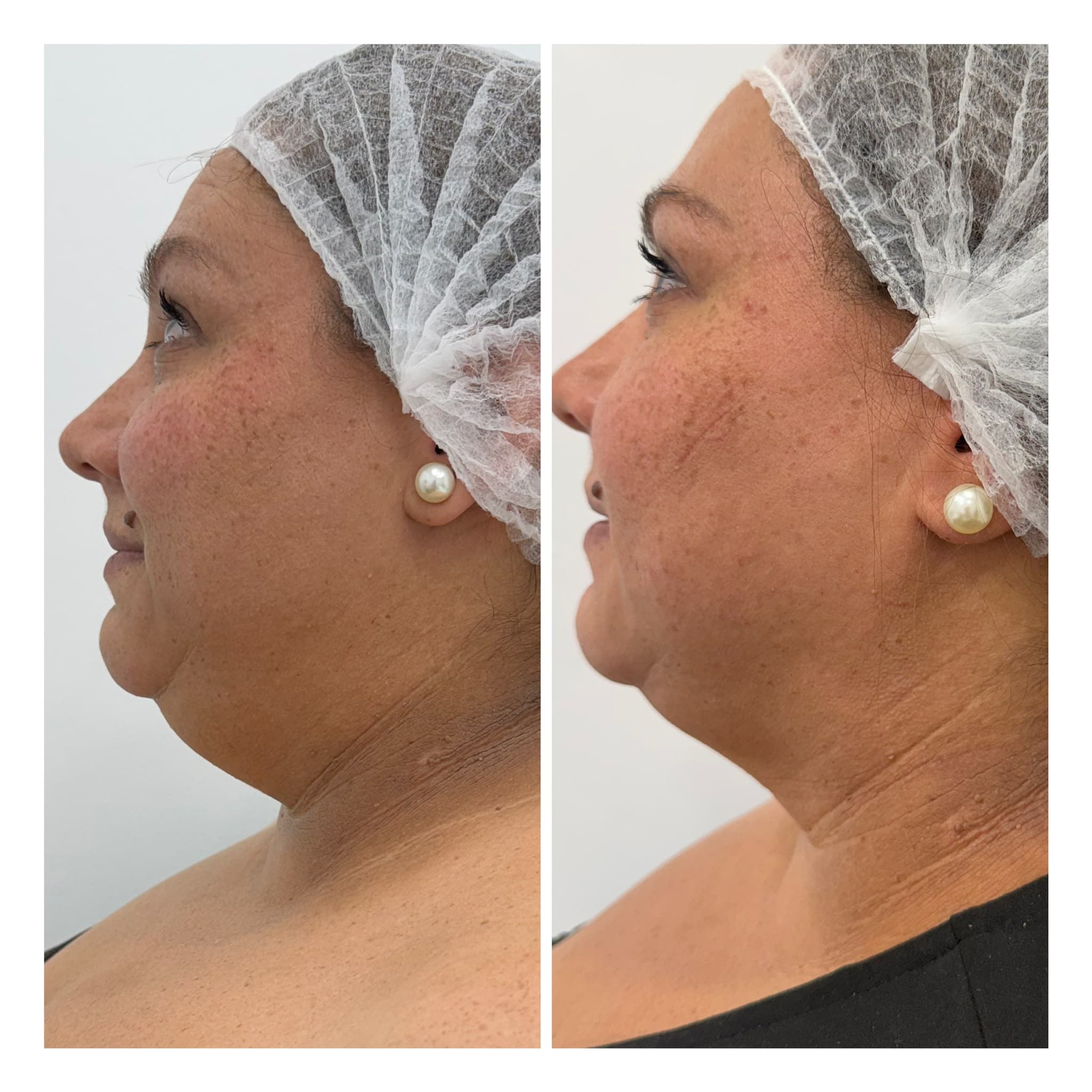 Antes y después de Smartlipo de papada en la clínica LAUSI de Madrid: perfil de paciente con el ángulo entre mandíbula y cuello más definido tras la lipólisis láser